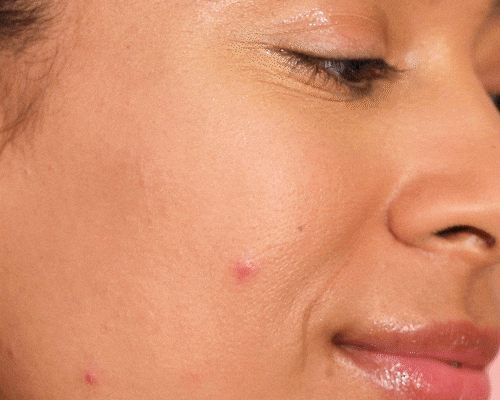 Period Skin: Why You Break Out Around Your Cycle (And What To Do About It)